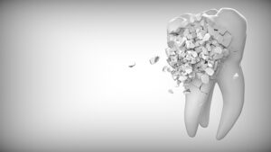Cheap Dental implants 2021 Boston, LA, chicago, dallas, baltimore, indianapolis