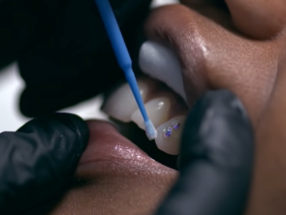 What is the cost of tooth piercing and tooth gems? Are they safe?