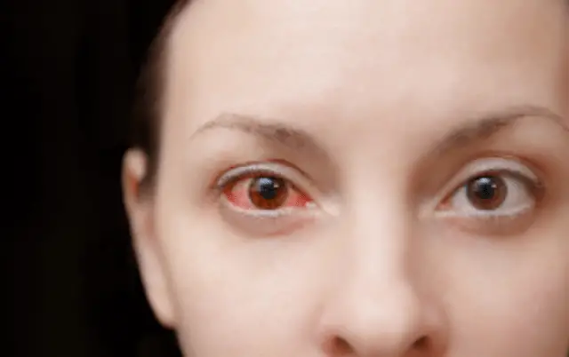 Remedies and Causes of Broken Blood Vessel in Eye With Headache