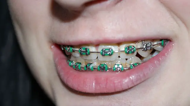 How to Remove Braces at Home?