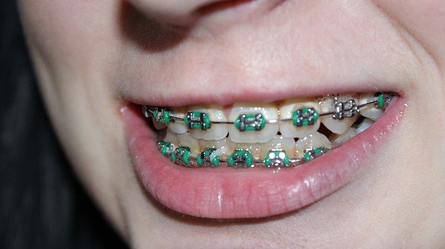 How to Make Fake Braces at Home?