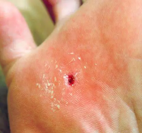 Wart That Fell Off and Left a Hole in My Skin