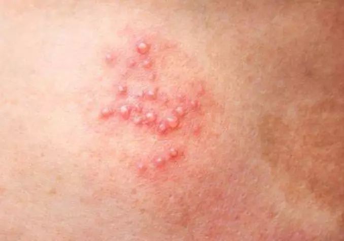When is it Too Late to Take an Antiviral For Shingles?