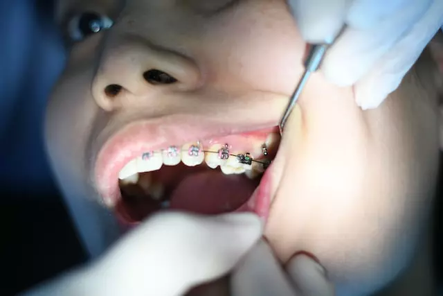 How Much Do Braces Hurt on a Scale 1-10?