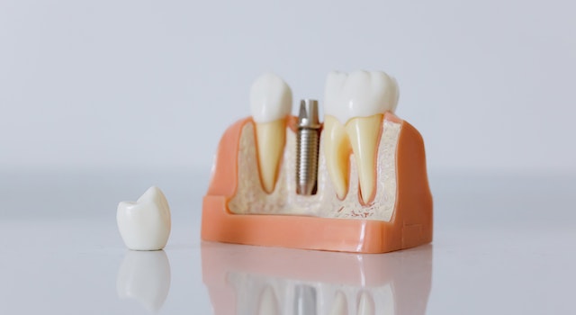 How to Get a Single Tooth Implant Cost Without Insurance?