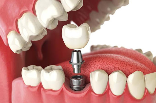 The Ultimate Guide to Dental Implants: How They Can Prove Super Beneficial?