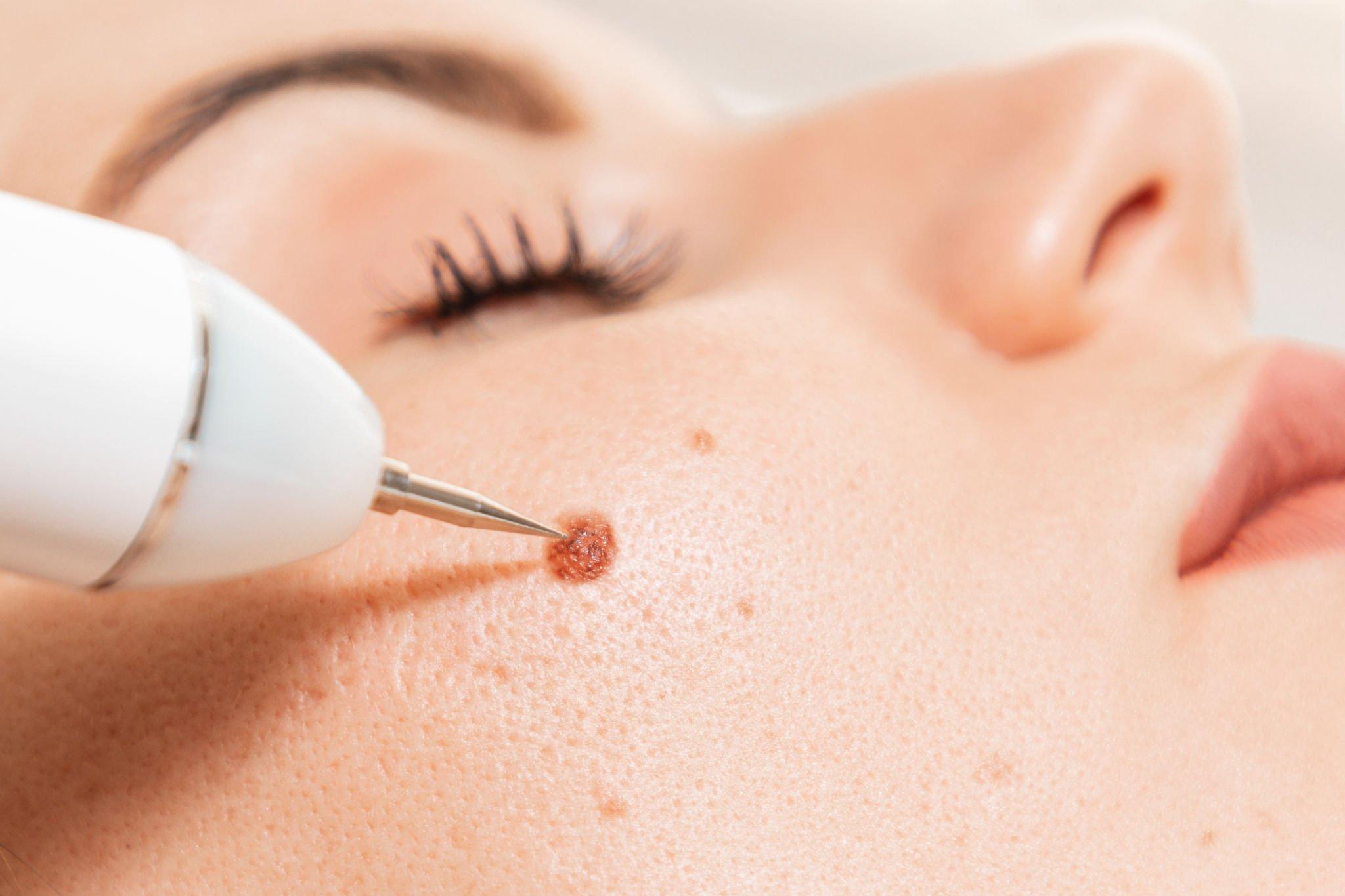 Everything you need to know about skin moles: Identifying and removing them