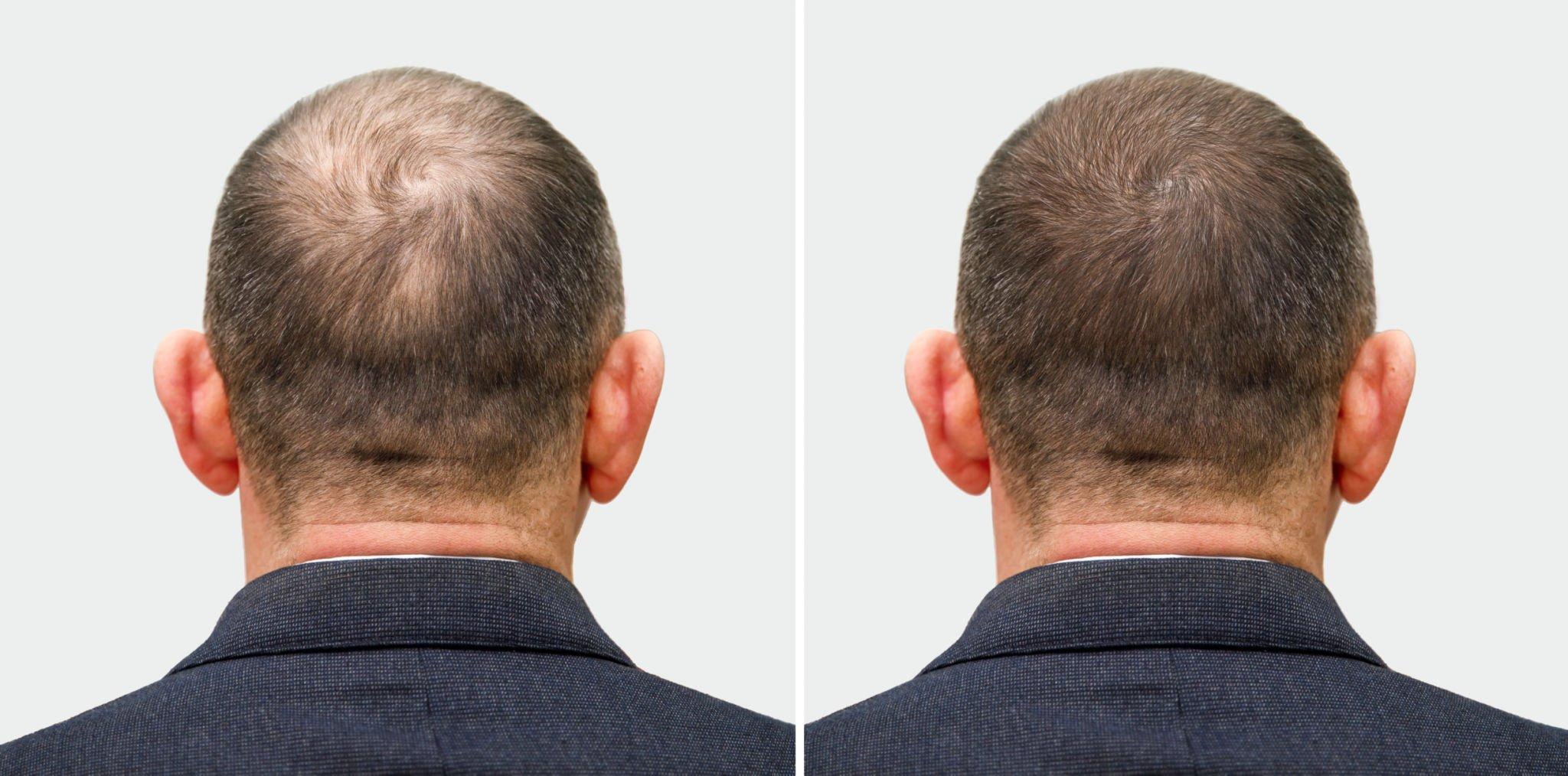 Can You Wash Your Hair Normally After a Hair Transplant?